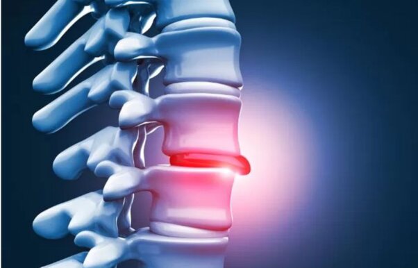 fisioterapia ernia del disco a Roccella Ionica